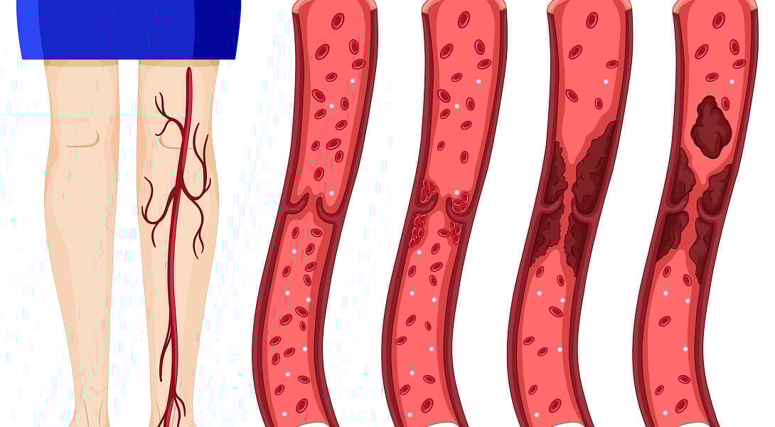 Co jeść przy zakrzepicy