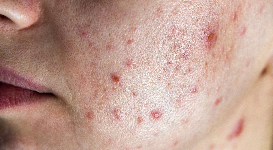Czego nie jeść przy trądziku