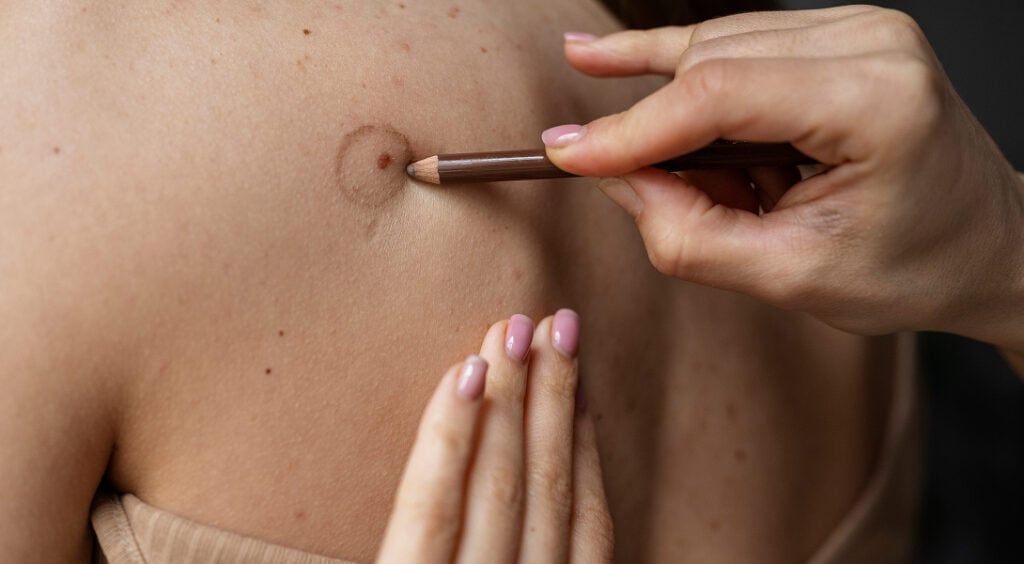 Czego nie jeść przy czerniaku