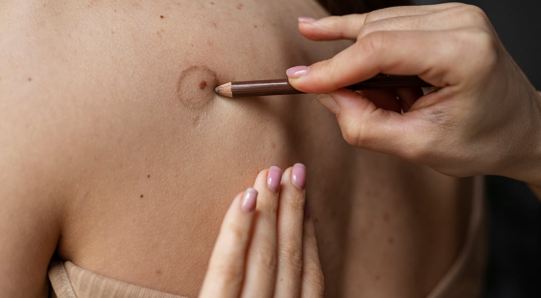 Czego nie jeść przy czerniaku